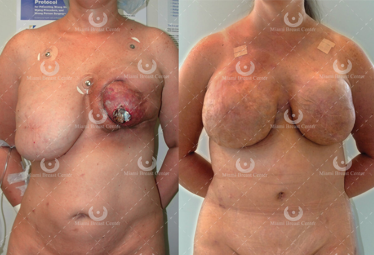 breast reconstruction surgery after failed implant