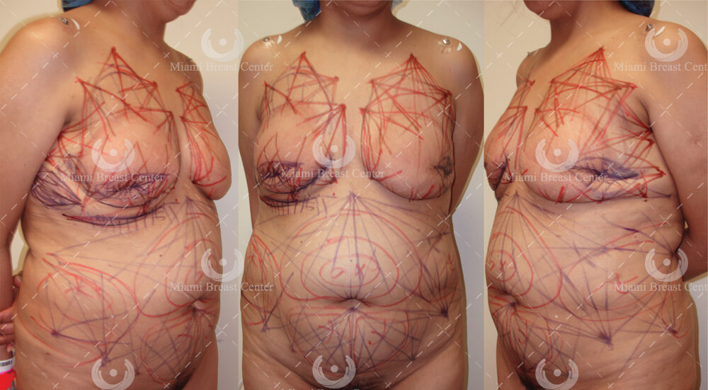 Am I too Thin or Skinny for Our Fat Transfer to the Breast Procedure? -  Miami Breast Center