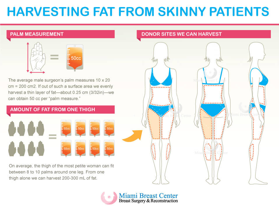 Breast Fat Transfer: From 32A to 32C - 42 years old, with kids 