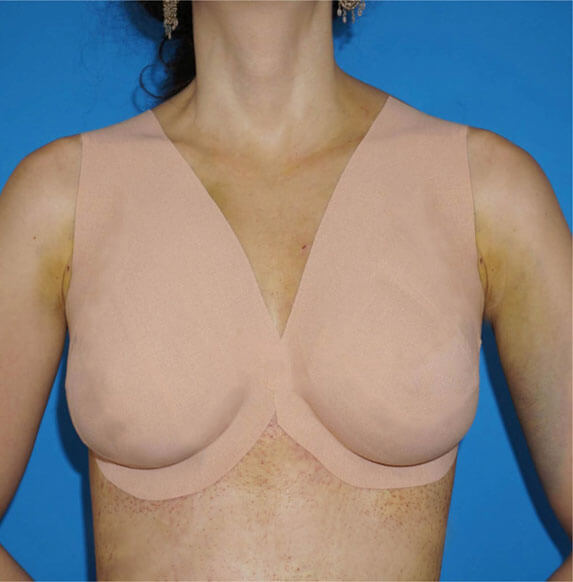 Natural Breast Lift Without Incisions or Implants - Miami Breast Center